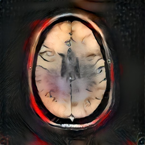 Brain on Tinman